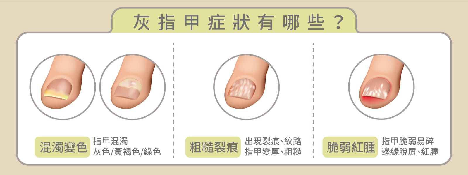 Discoloration, cracks, and fragility are common symptoms of fungal nail infection.